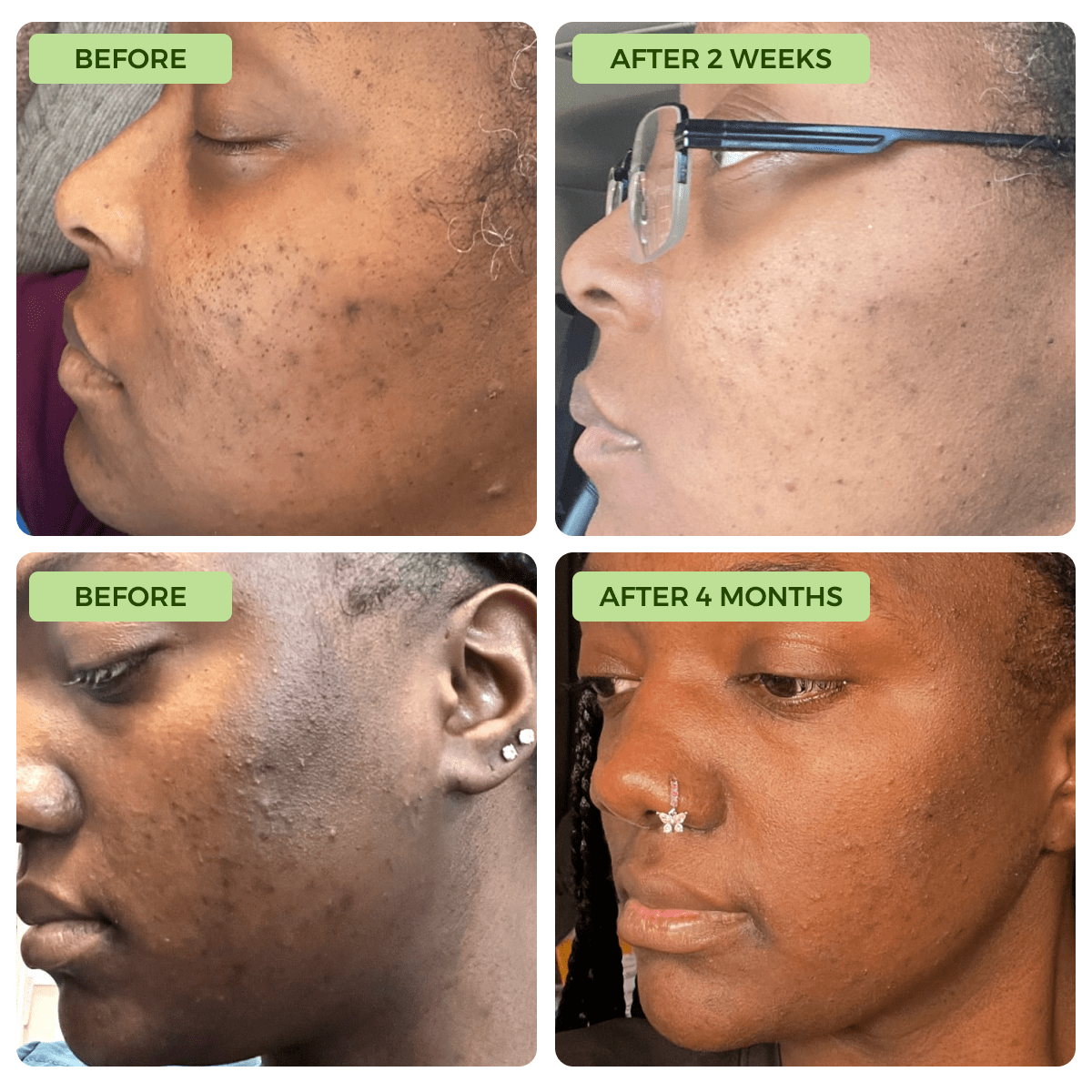 Anti-Acne & Dark Spots Bar