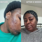 Anti-Acne & Blemish Bar.